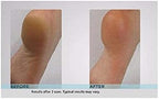 Turquoise Emjoi Micro-Pedi kit showing bonus replacement rollers and cleaning brush.