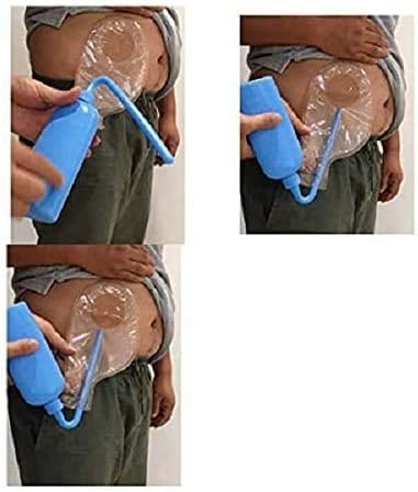 Reusable stoma care supplies rinse pot for clearing one piece drainable pouches