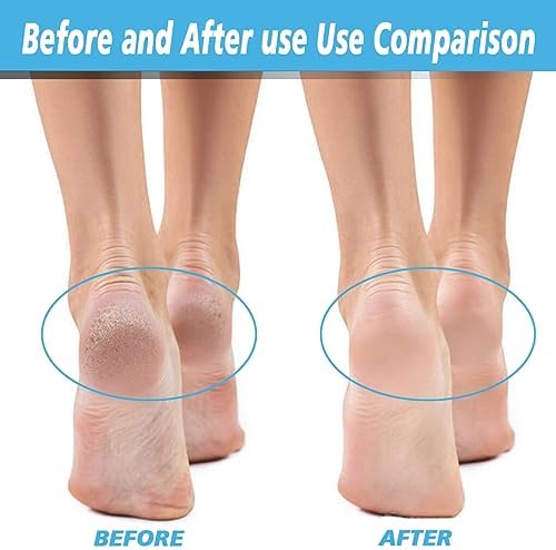 A complete set of 12 replacement rollers for professional at-home foot care.