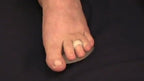 Gel support pads for crooked toes being worn inside a shoe for comfort.