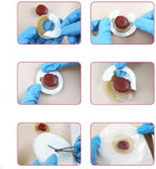 SLFJOSN hydrocolloid ostomy supply seal protecting peristomal skin surfaces