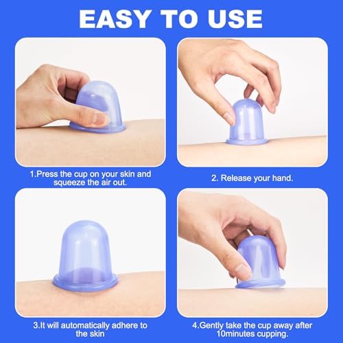 Blue silicone massage cups being squeezed for vacuum therapy application.