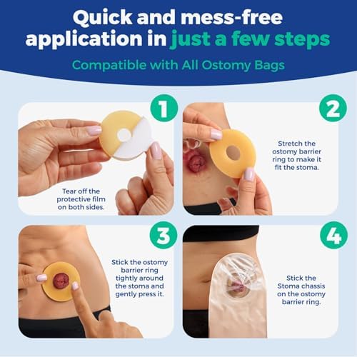 Waterproof colostomy bag adhesive ring demonstrating thickness and diameter