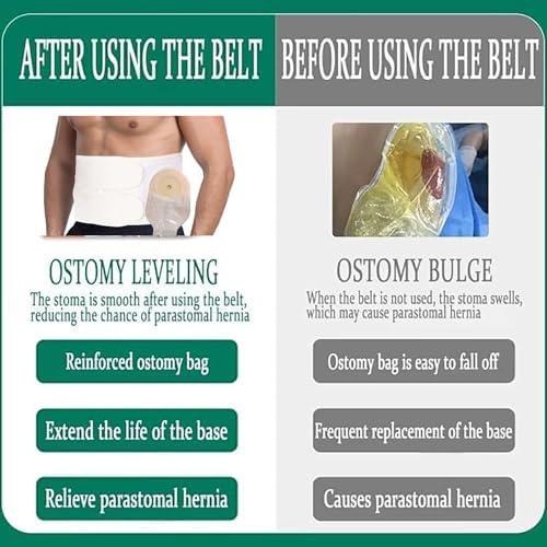 Low profile discreet fit demonstration of the Flosmore parastomal hernia prevention belt