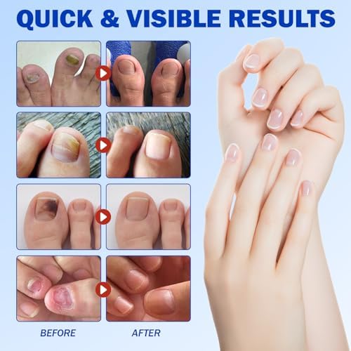 Before and after visualization of nail strengthening and discoloration improvement.