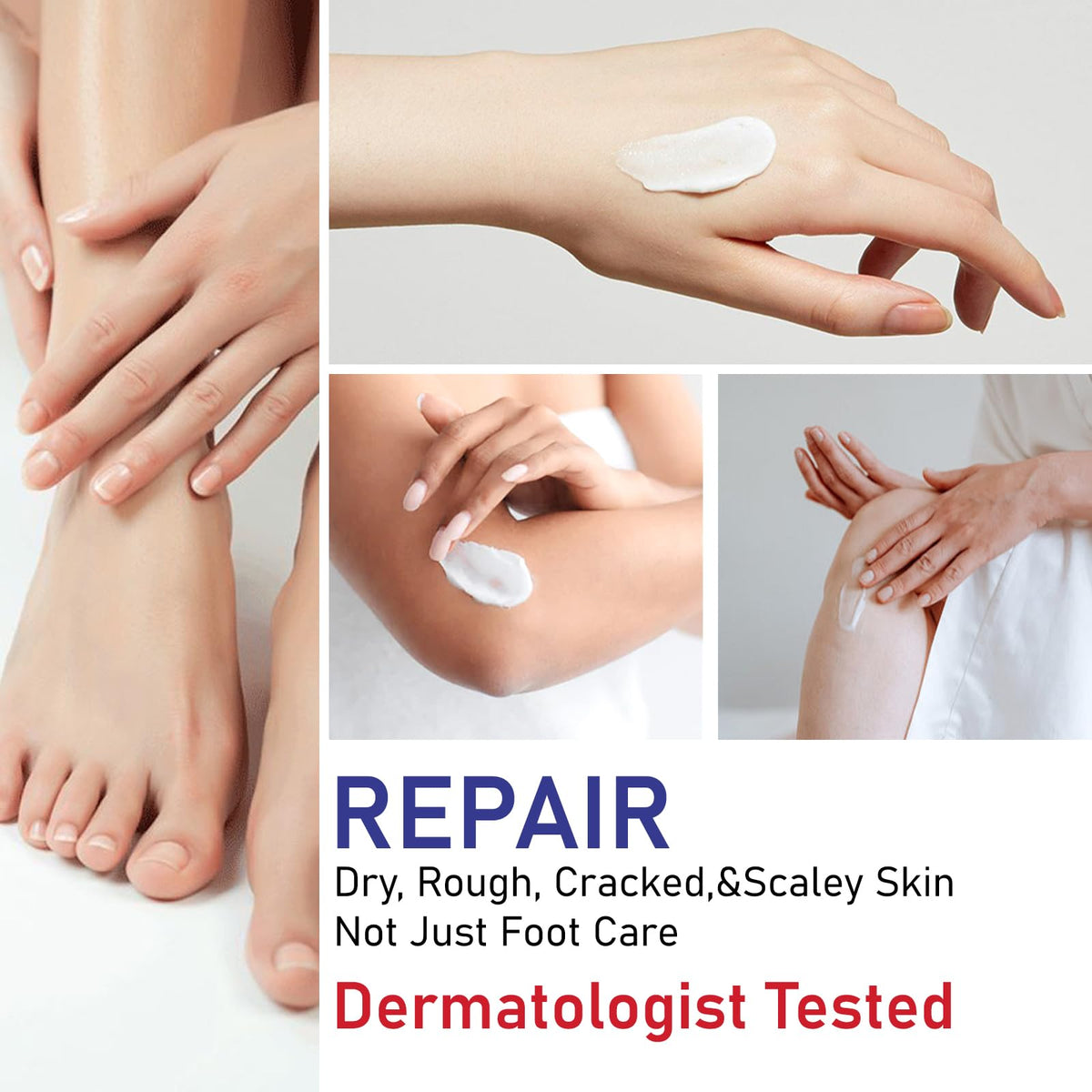 Application of OUKEYA forty percent urea cream on extremely dry skin area