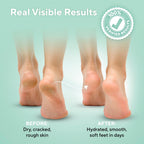 Lavinso rough skin repair cream for treating calluses and dry cracked heels
