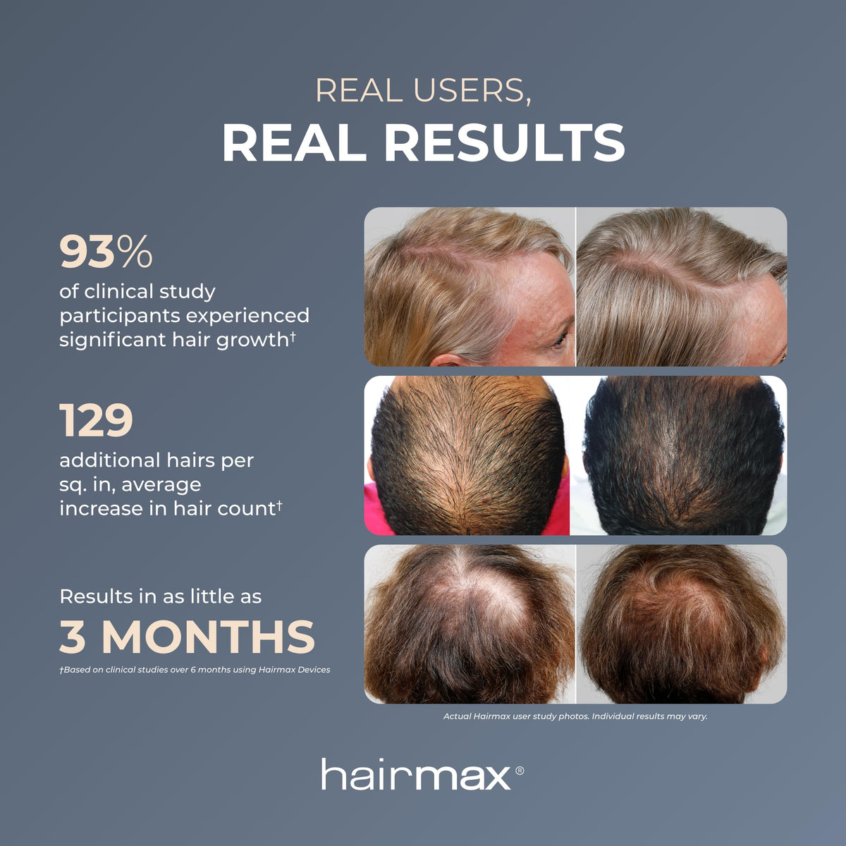 Side view of Hairmax RegrowMD device on a model