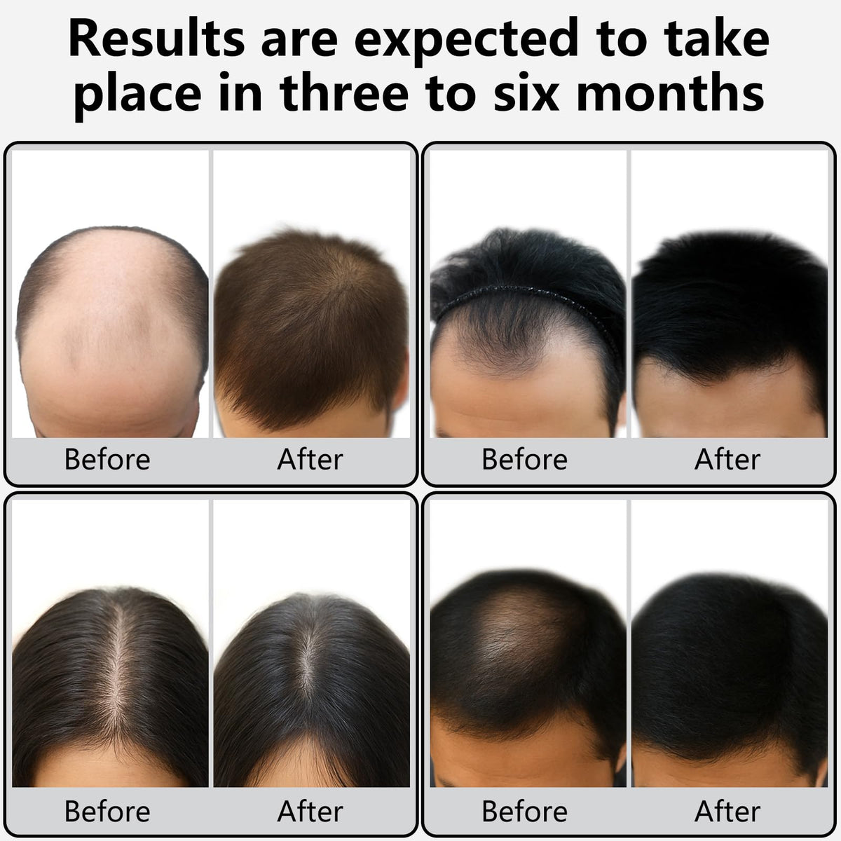 Electric scalp massager bristles for hair density support.