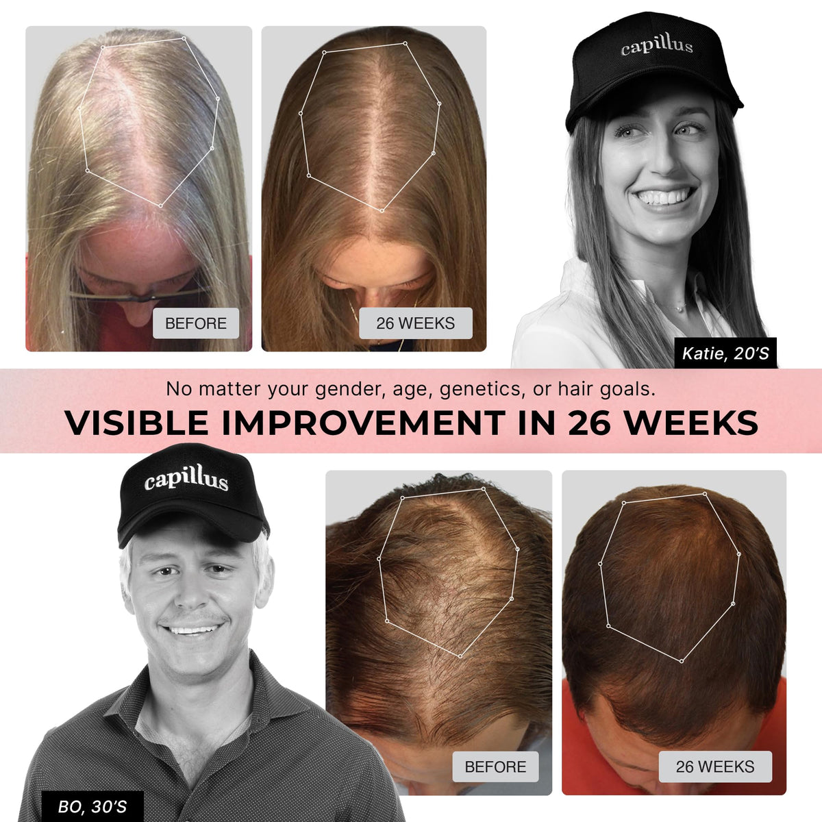 Capillus Pro laser hair therapy device side profile