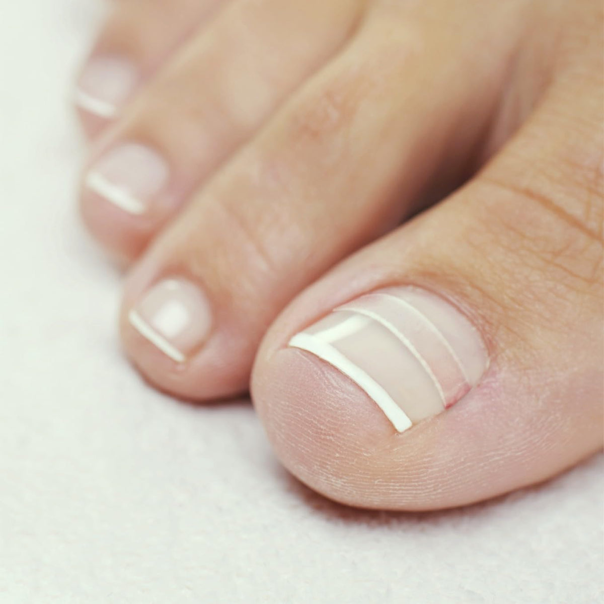 Clinical style packaging of CurveCorrect ingrown toenail kit