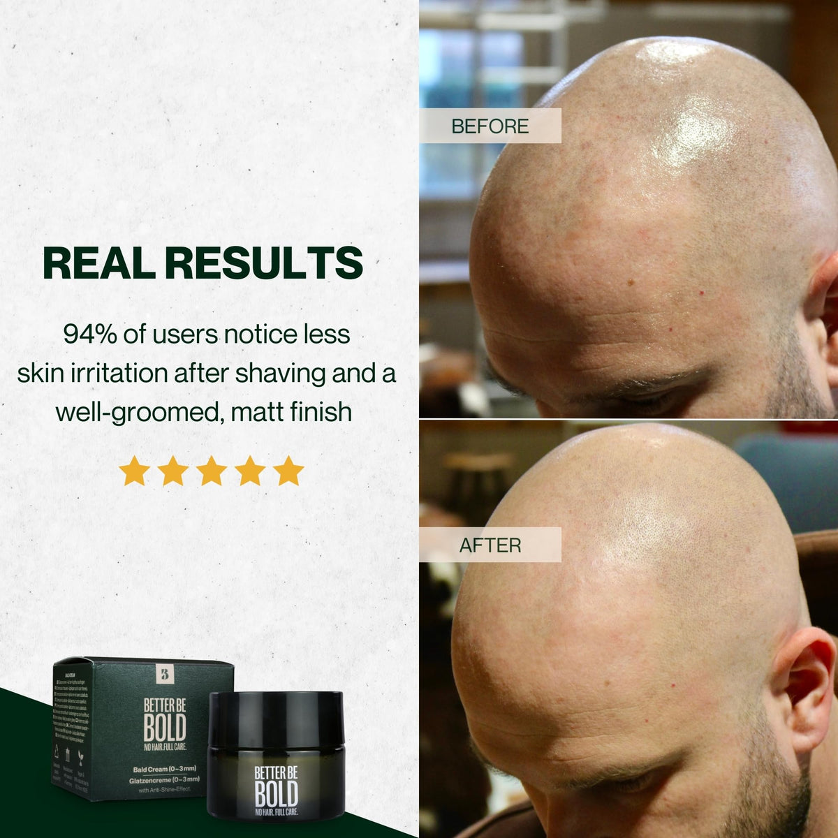 Dermatologist tested German bald care cream for zero to three millimeter shaved scalps