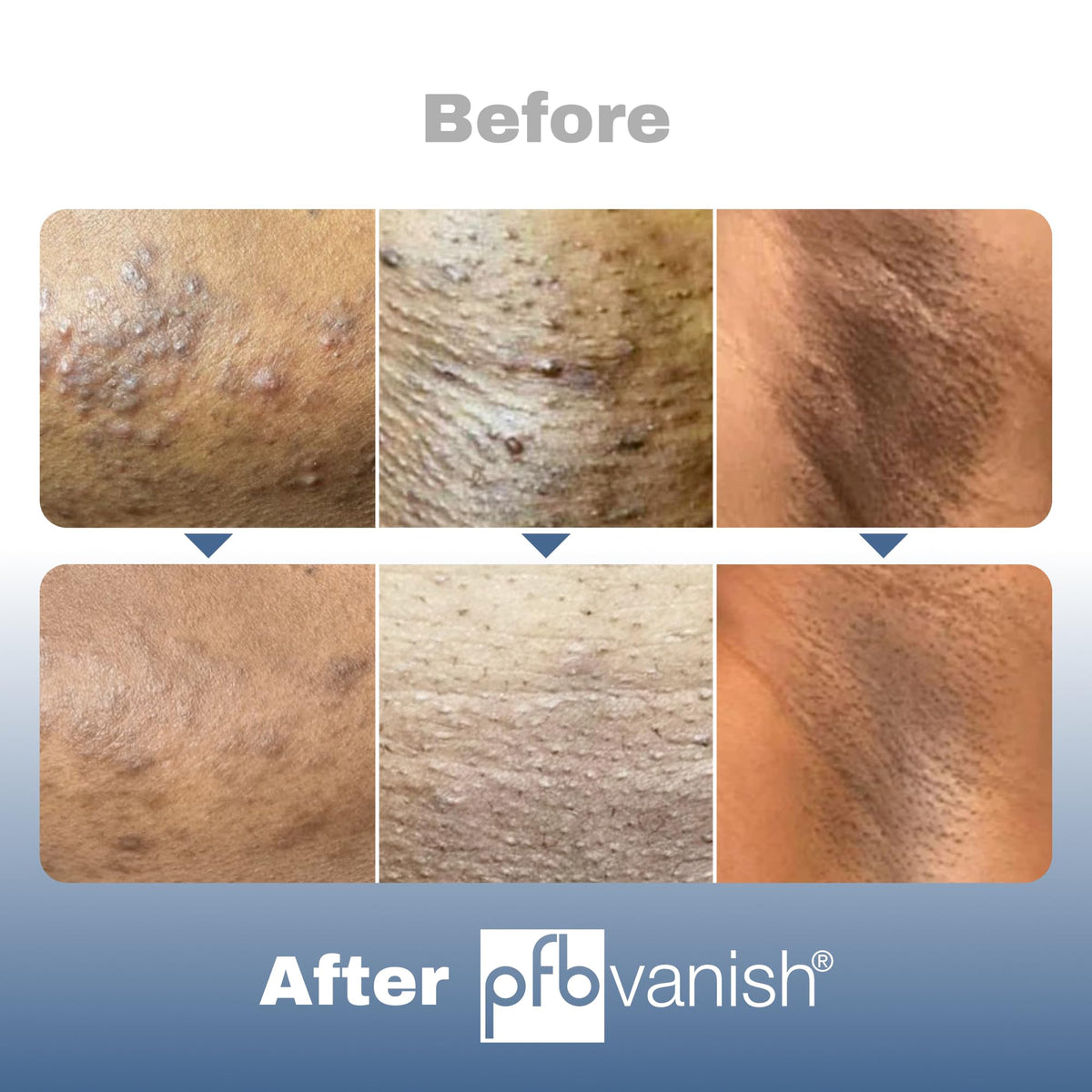 Side view of PFB Vanish Ultra dark spot remover packaging