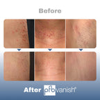 PFB Vanish skincare treatment targeting hyperpigmentation and razor dark spots