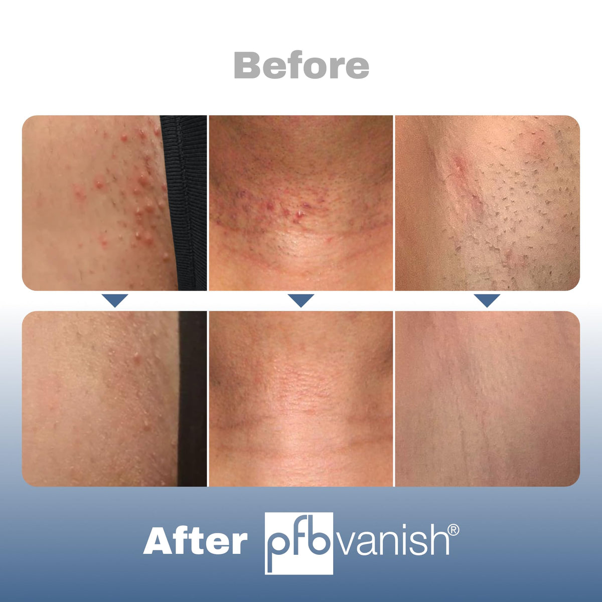PFB Vanish skincare treatment targeting hyperpigmentation and razor dark spots