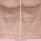Skincare results after using Dekliderm neck firming cream