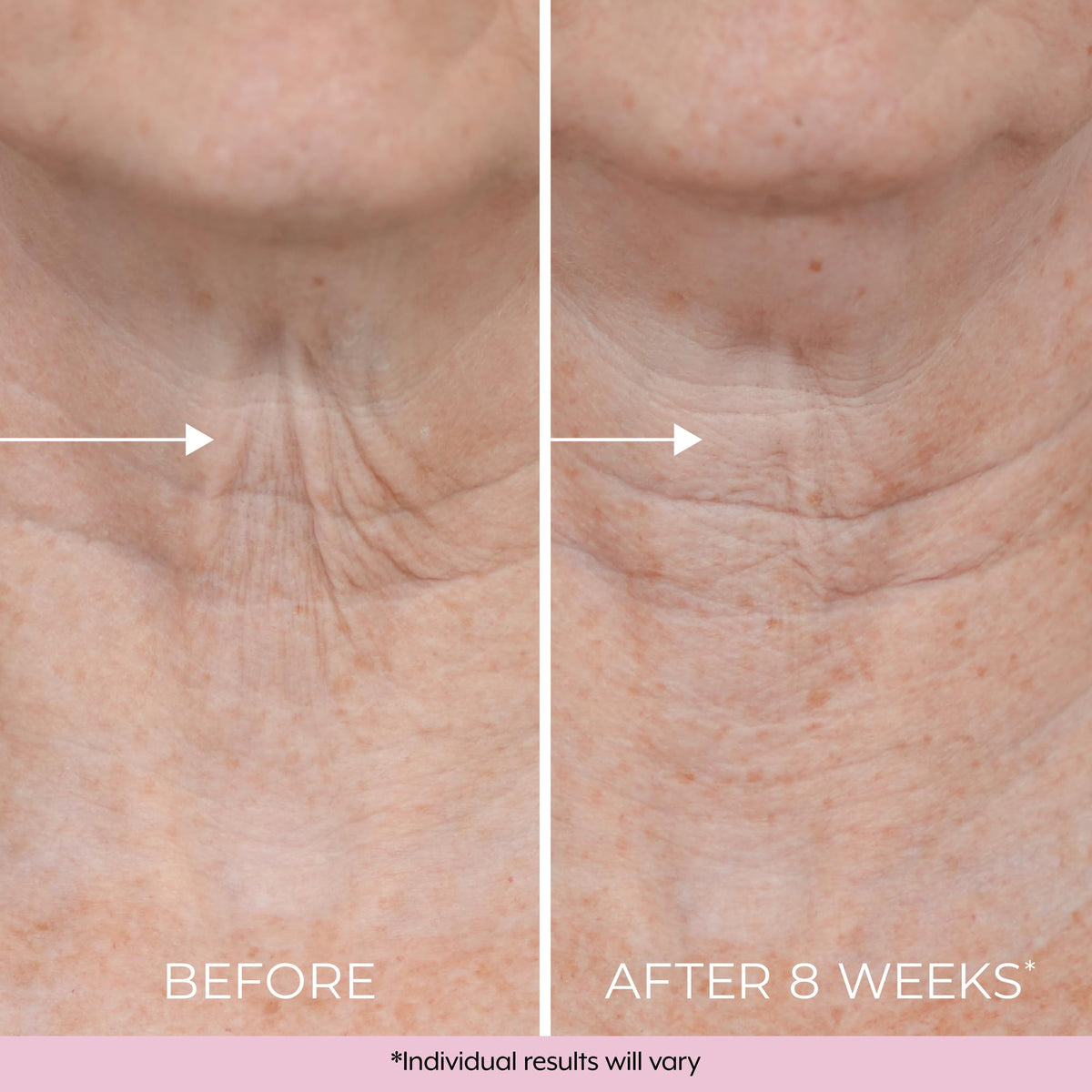 Skincare results after using Dekliderm neck firming cream