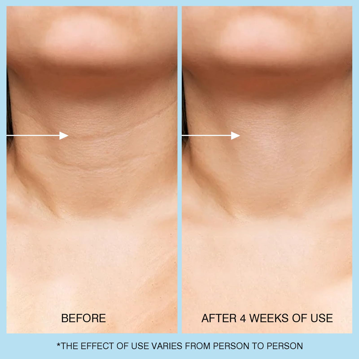 Benefits of Ujhay Retinol Hyaluronic Acid Caffeine Cream
