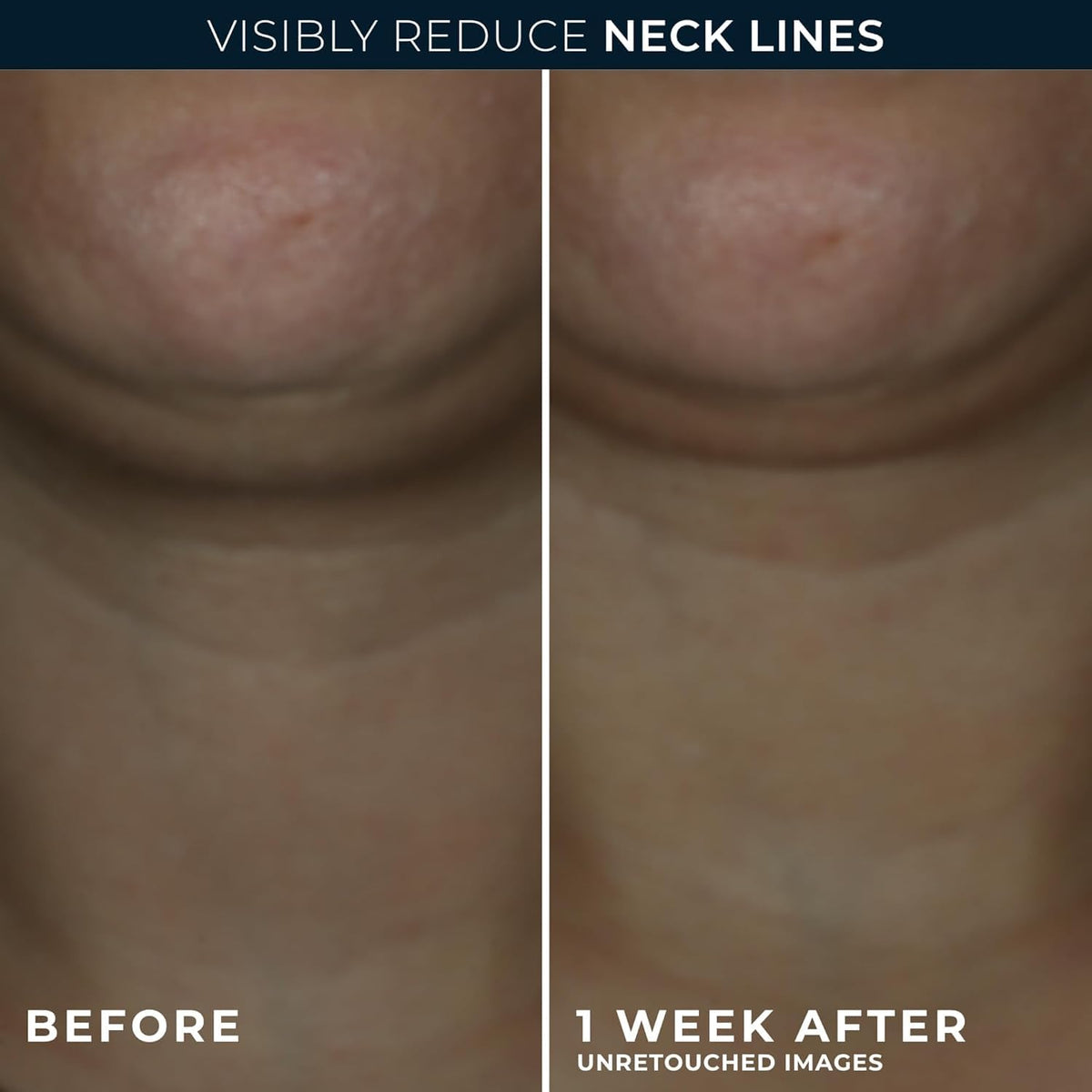 RoC neck cream packaging showcasing advanced retinol and hyaluronic acid