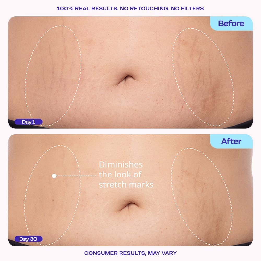 GOPURE stretch mark reduction moisturizer container on a clean background for body care routines