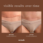 Nemah restorative ointment being applied to support skin elasticity and reduce acne marks.
