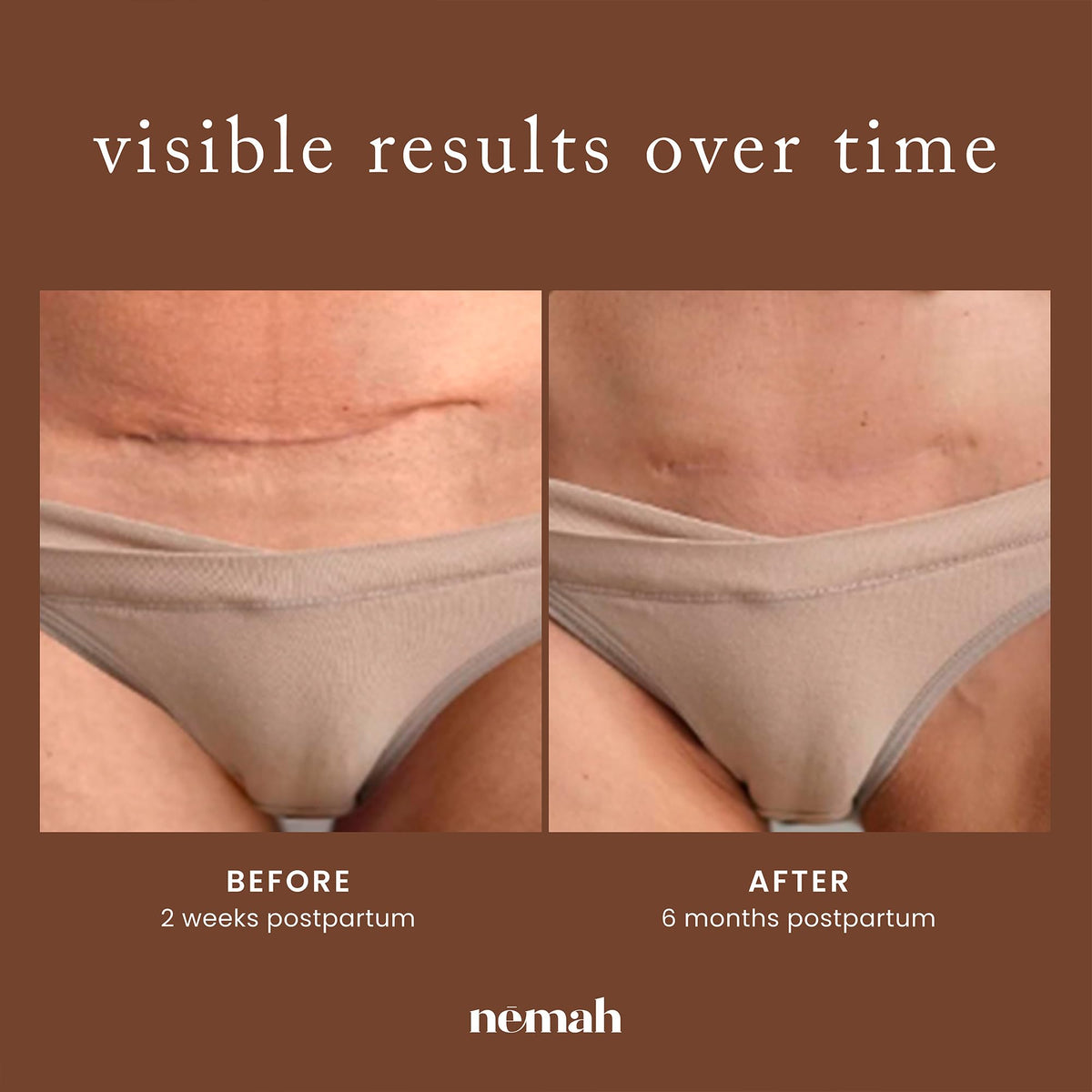 Nemah restorative ointment being applied to support skin elasticity and reduce acne marks.