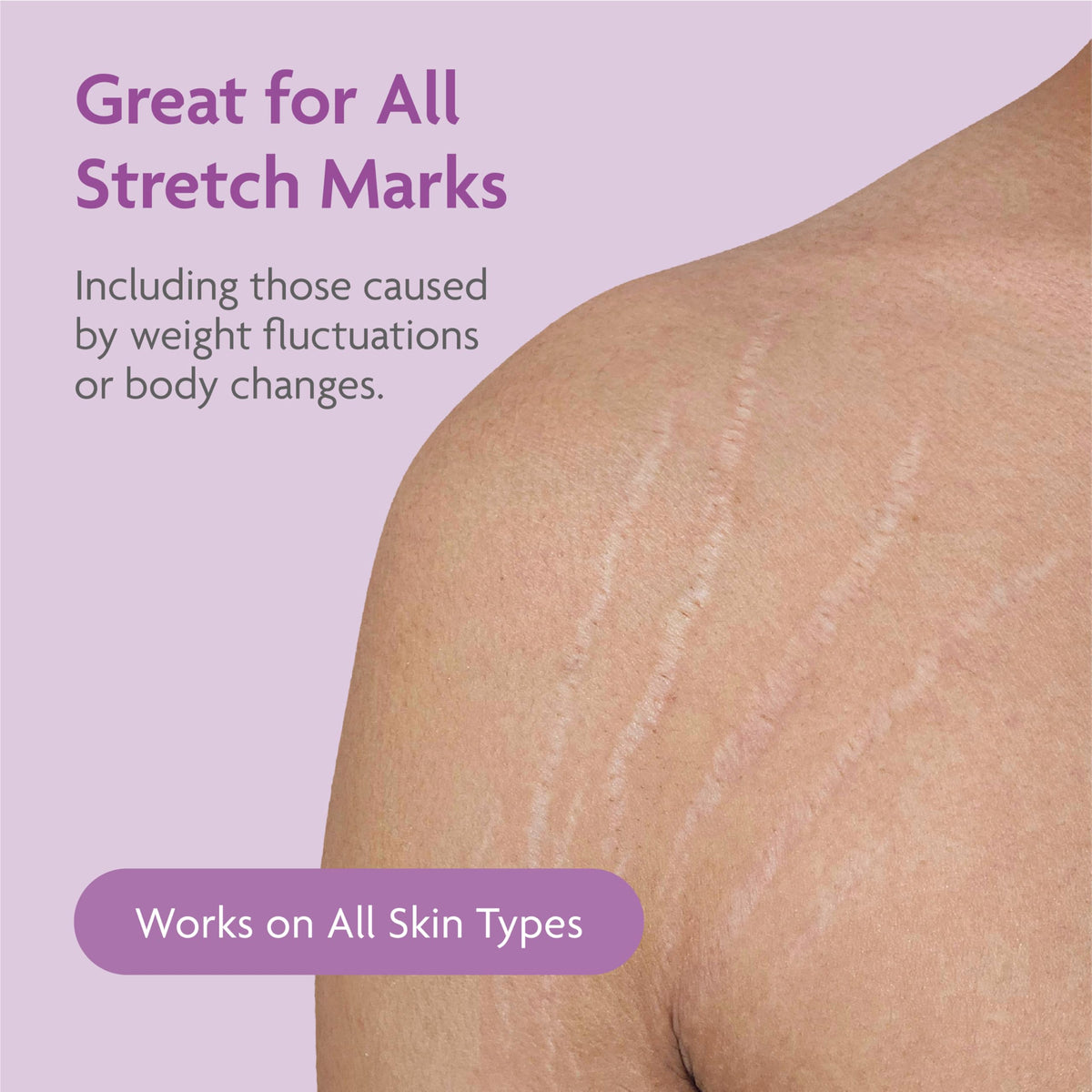 TriLASTIN paraben free unscented lotion for bodybuilding stretch marks