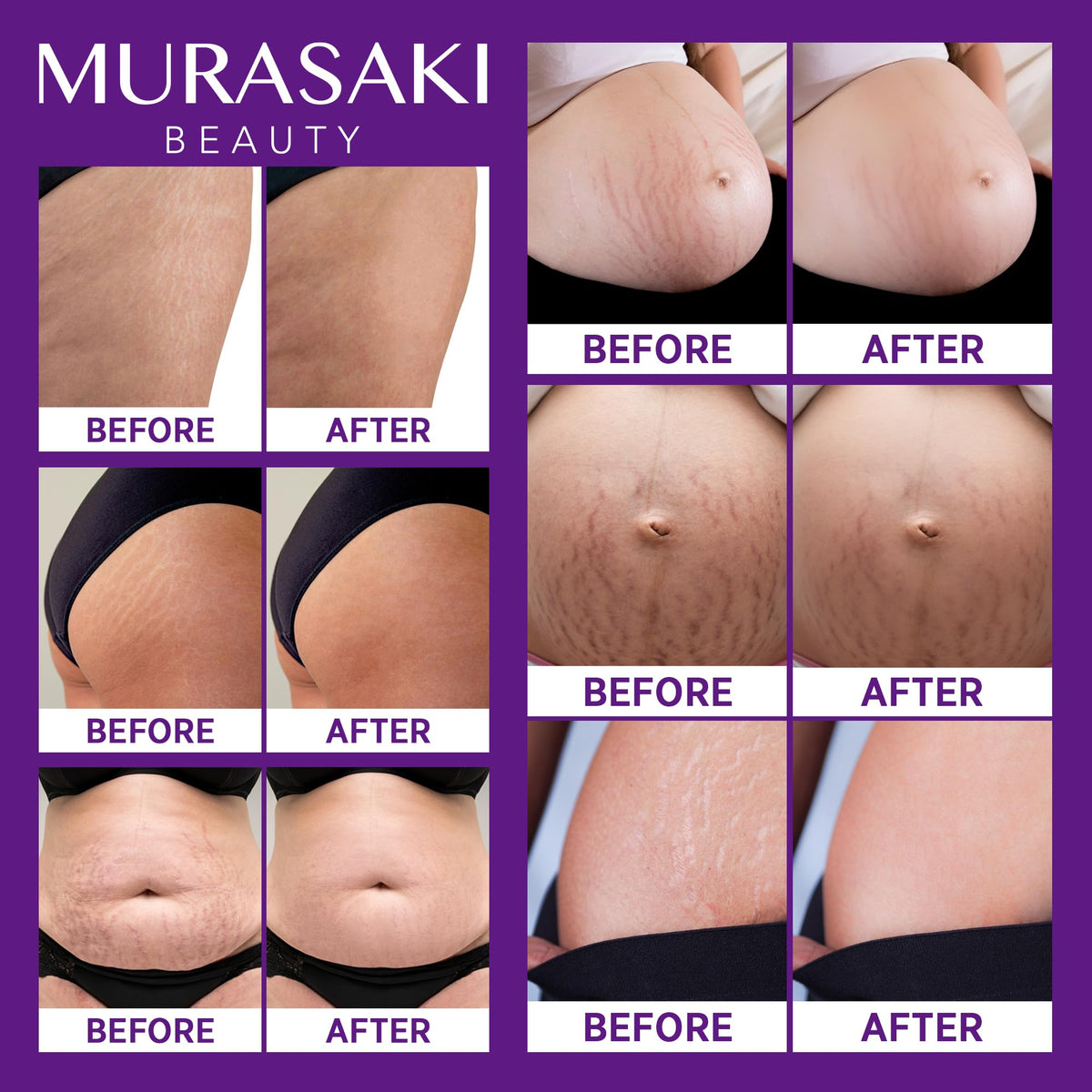 Nourishing formula stretch mark cream highlighting ingredients like hyaluronic acid and peptides.