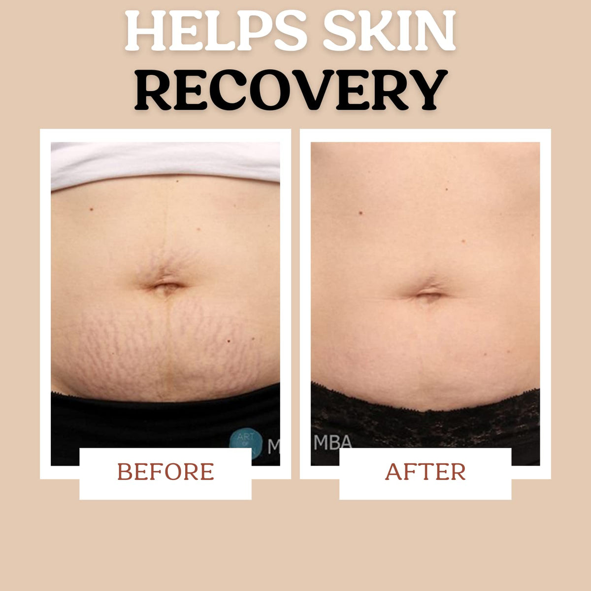 Applying Roe Wellness sensitive skin lotion on belly to increase skin elasticity