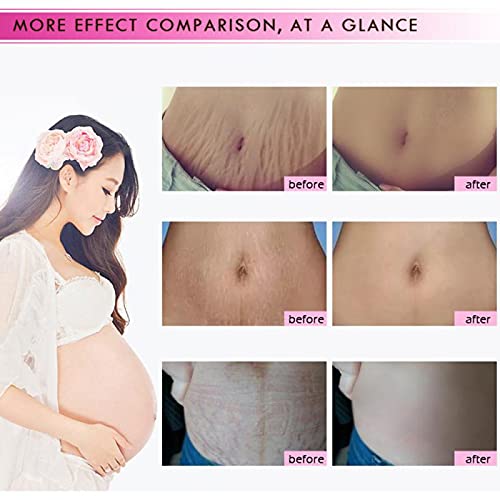 Side view of non greasy fast absorbing pregnancy scar cream