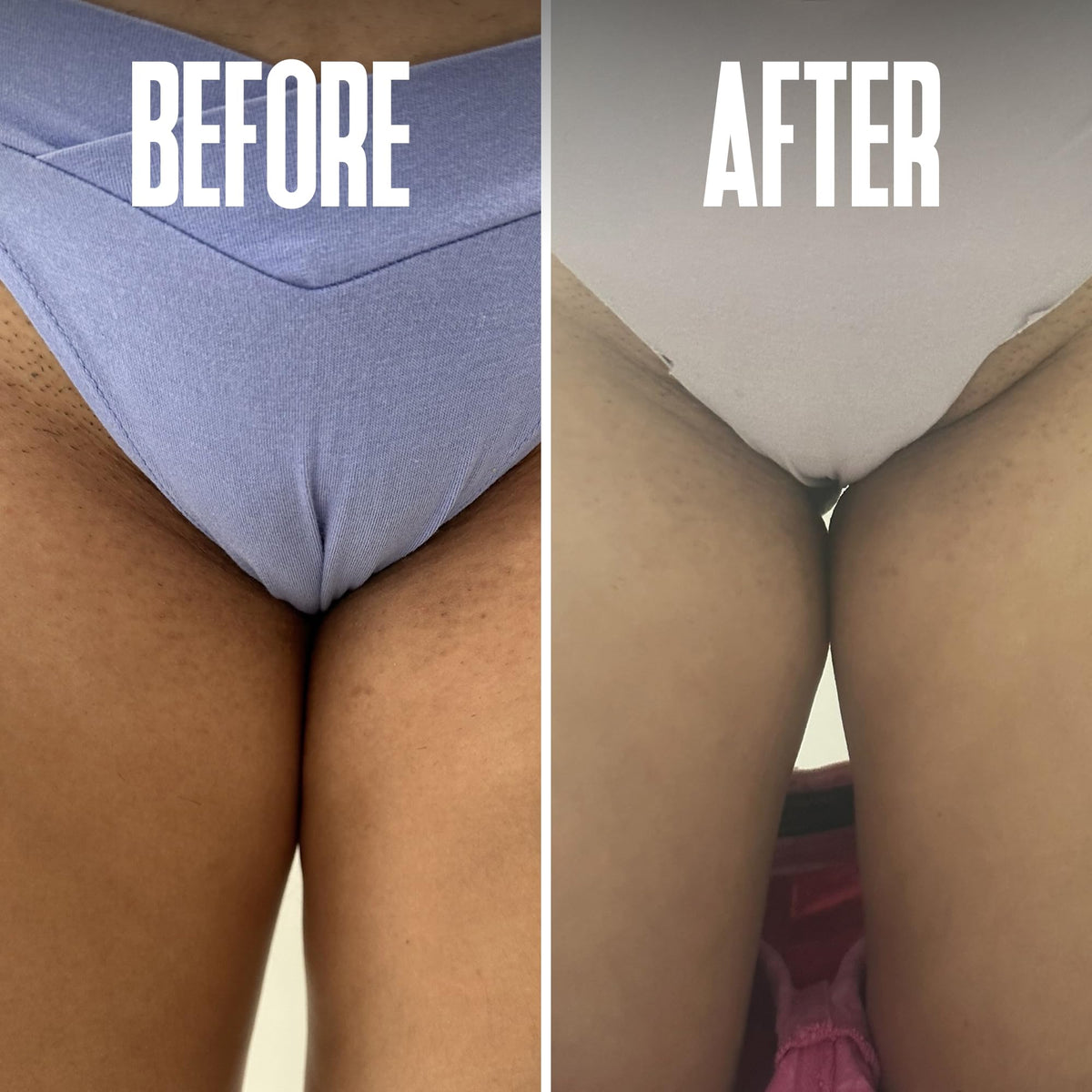 Divine Derriere salicylic and glycolic acid treatment pads for preventing pseudofolliculitis barbae